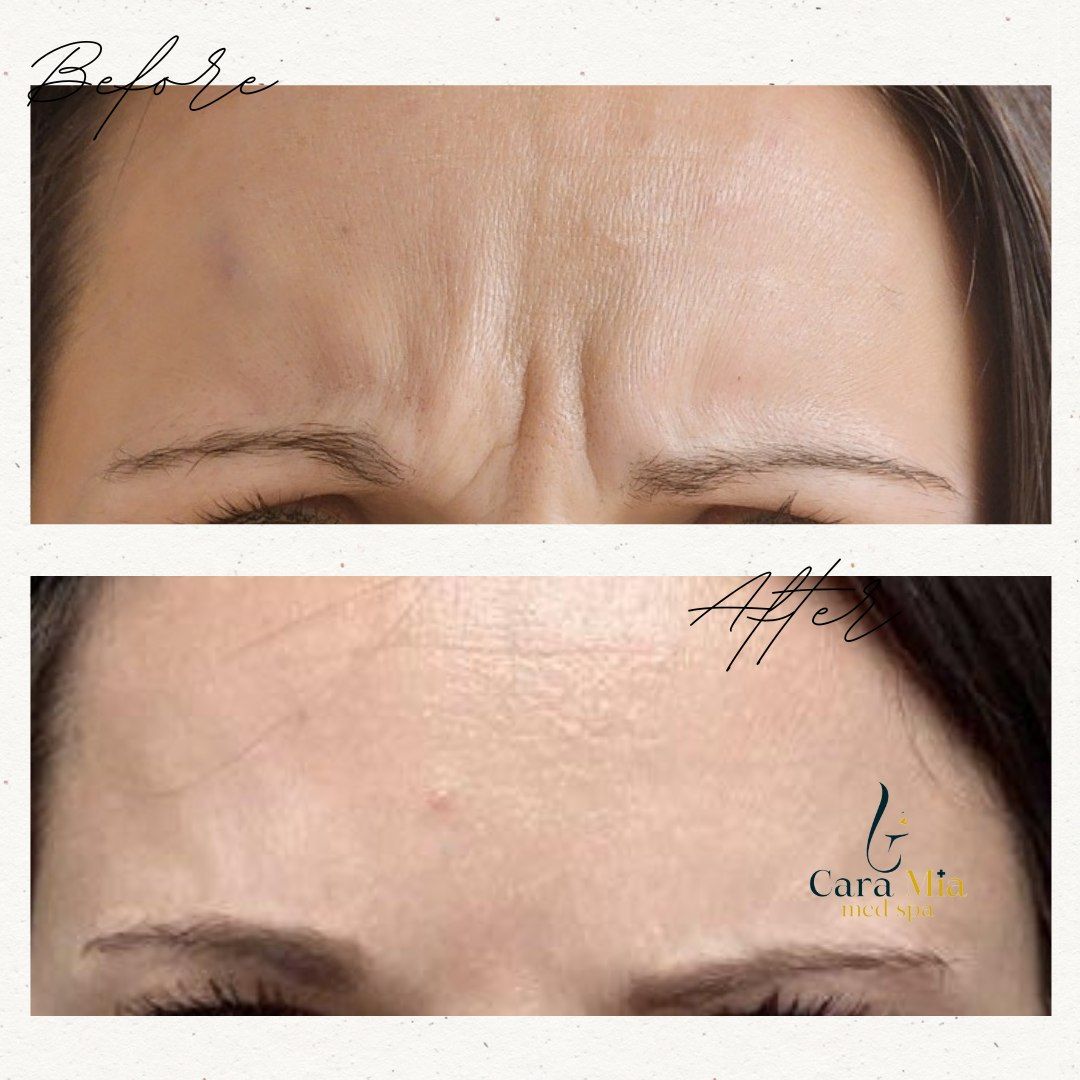 A woman 's forehead before and after botox injections.