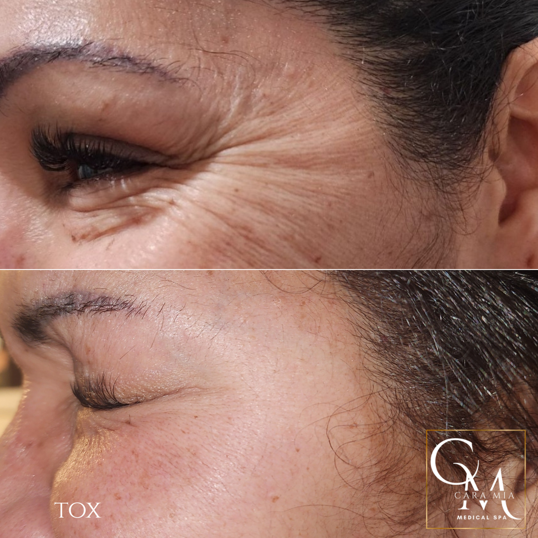 Before and after photos of woman's eye. Top shows wrinkles. Bottom shows smoother skin after toxin treatment.