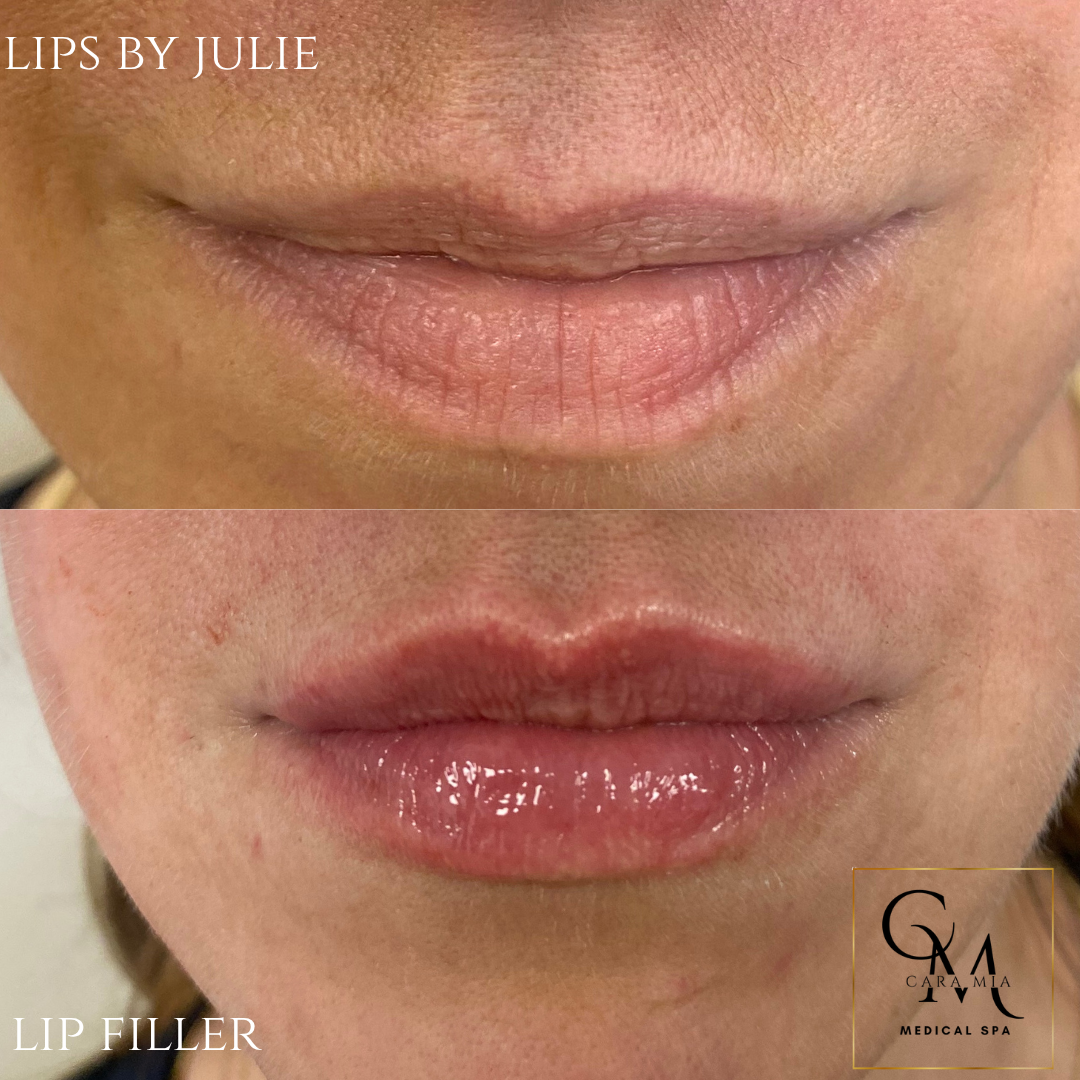 Before and after photos of lips; top lip is thinner, bottom lip is full and glossy after lip filler.