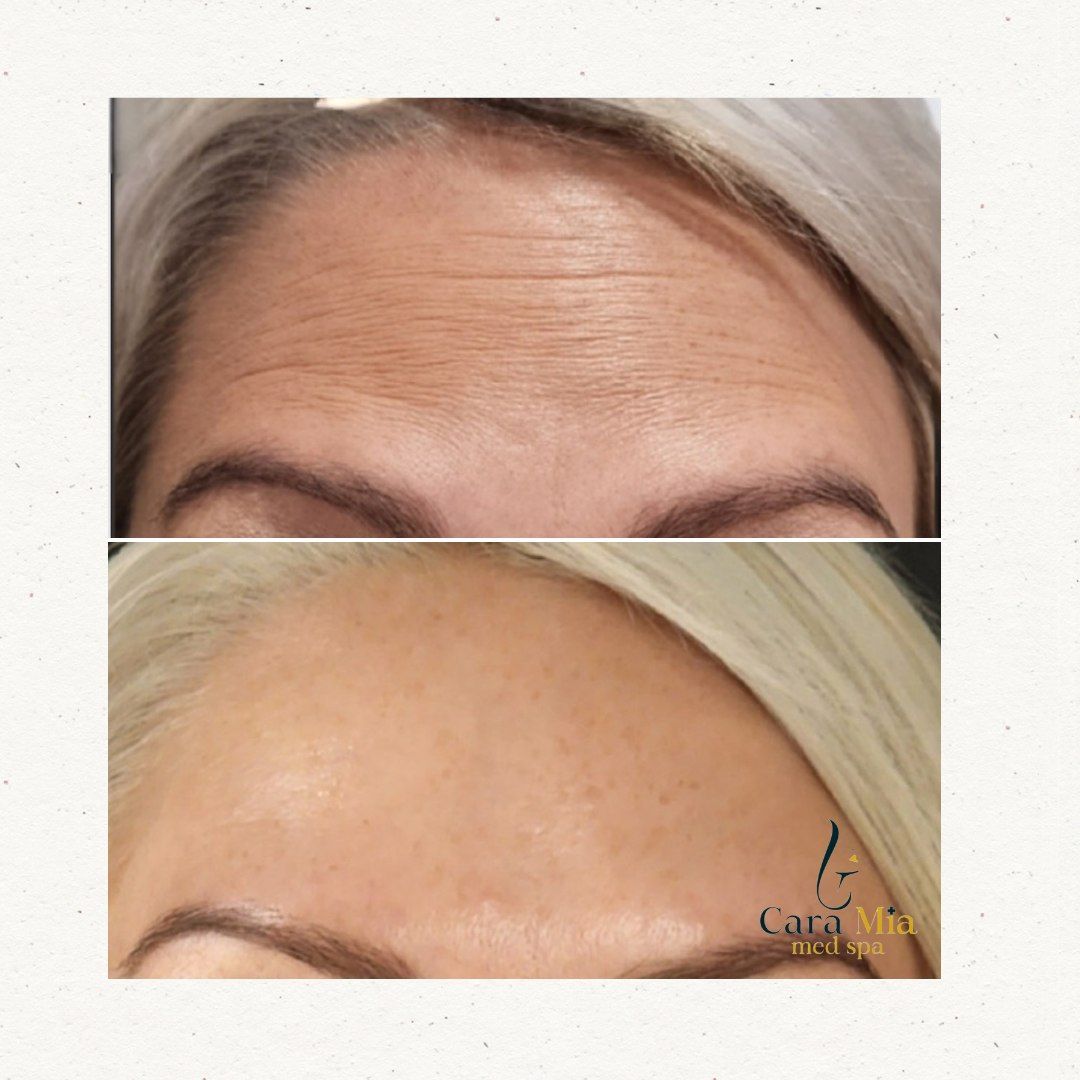 A before and after photo of a woman 's forehead