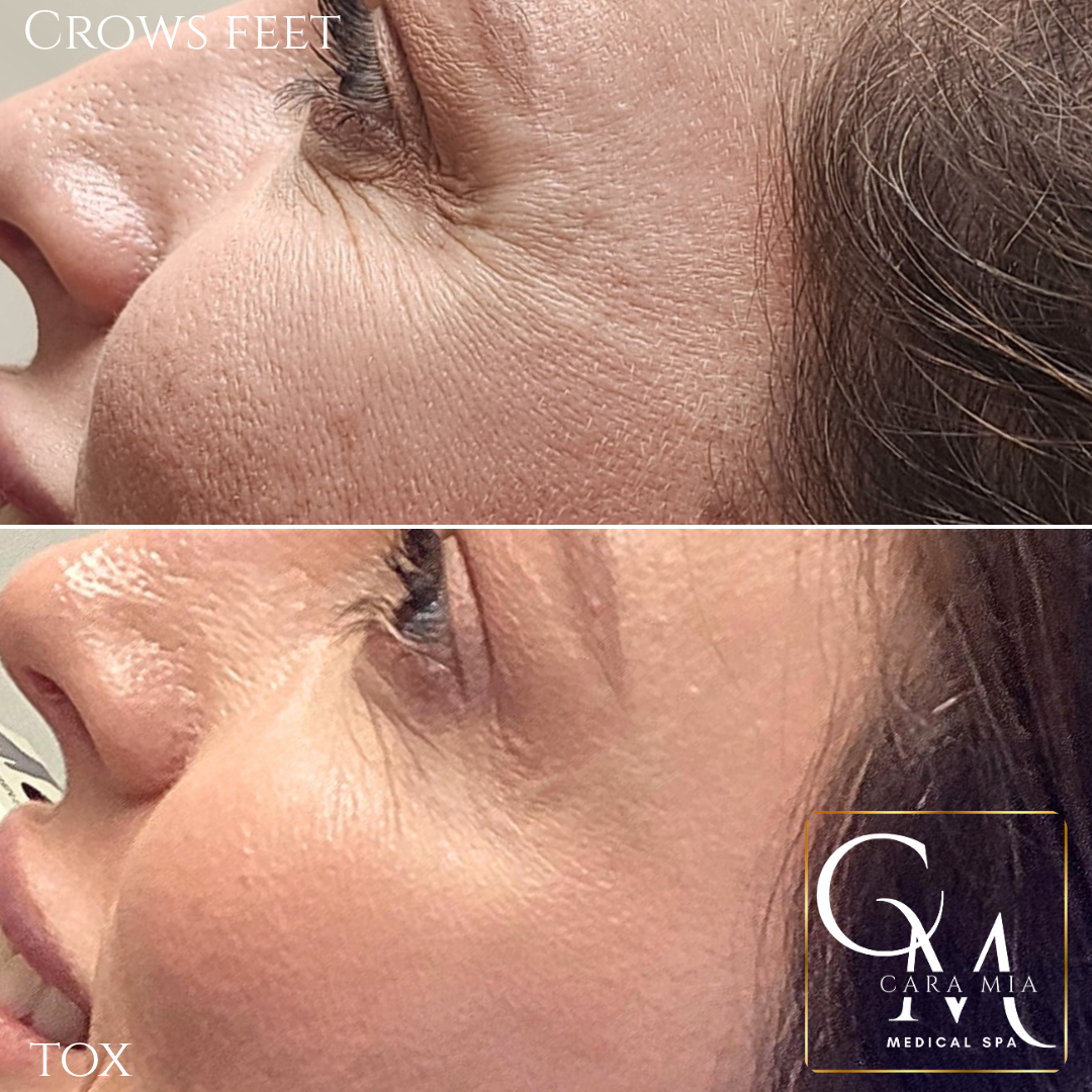 Comparison of woman's eye area showing reduced crow's feet wrinkles after a procedure.