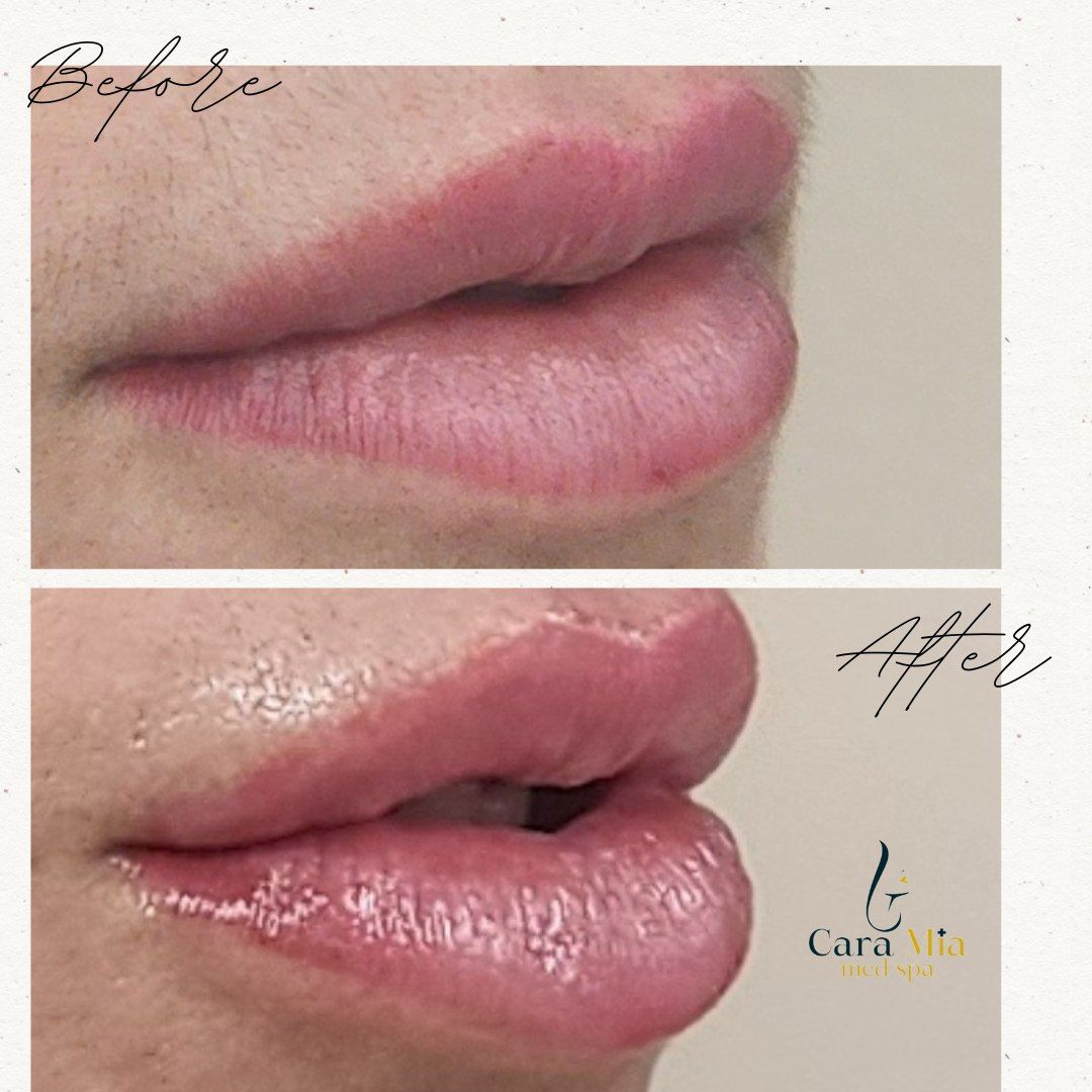 A before and after photo of a woman 's lips.