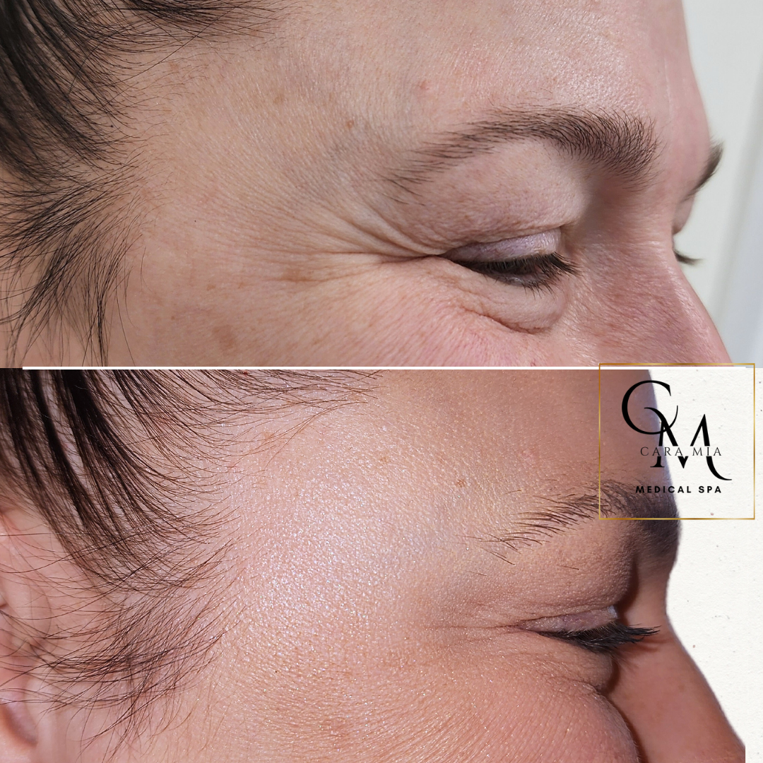 Before-and-after of a person's eye area. Top: Wrinkles. Bottom: Smoother skin after treatment.