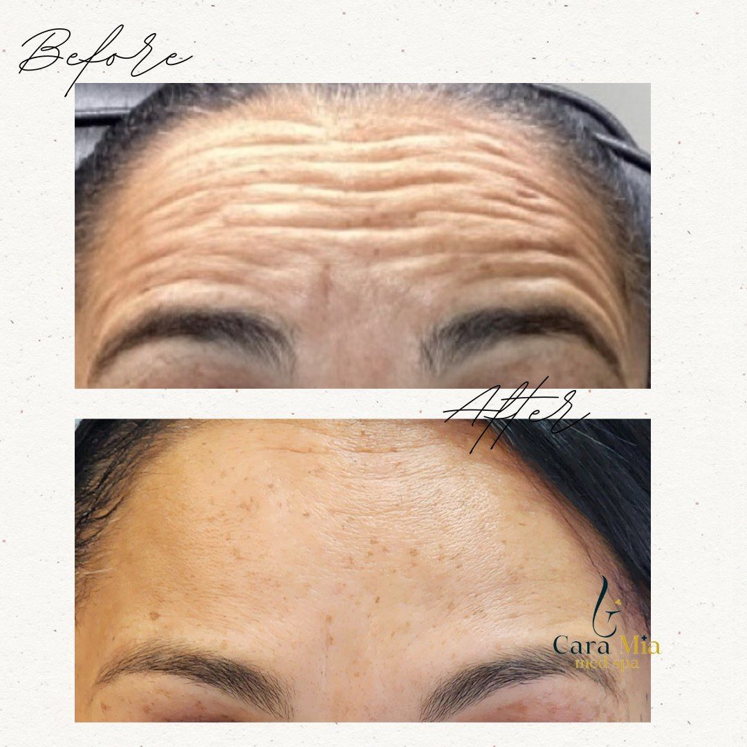 A woman 's forehead before and after botox injections.