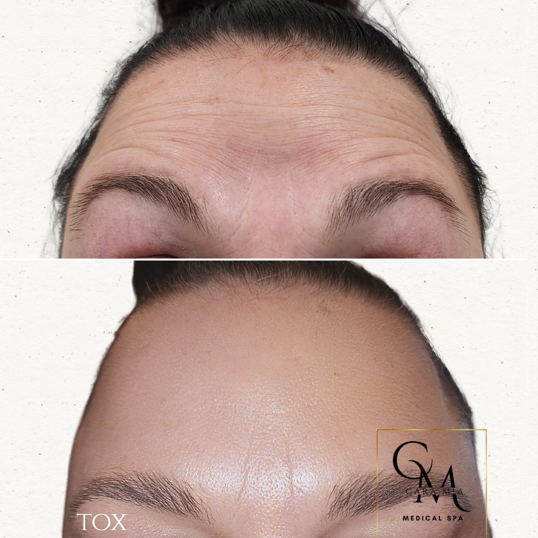 Forehead with wrinkles (top) vs. smooth forehead after treatment (bottom).