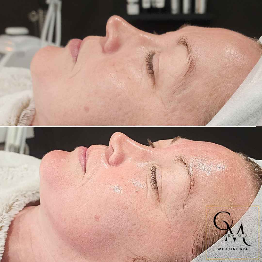 Side-by-side photos of a person's face before and after a spa treatment. Skin appears brighter and smoother in the after photo.