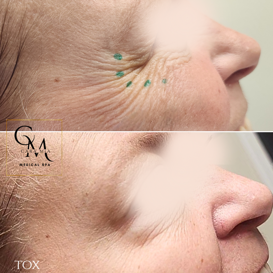 Before and after of a person's cheek with wrinkle reduction; green dots mark injection sites.