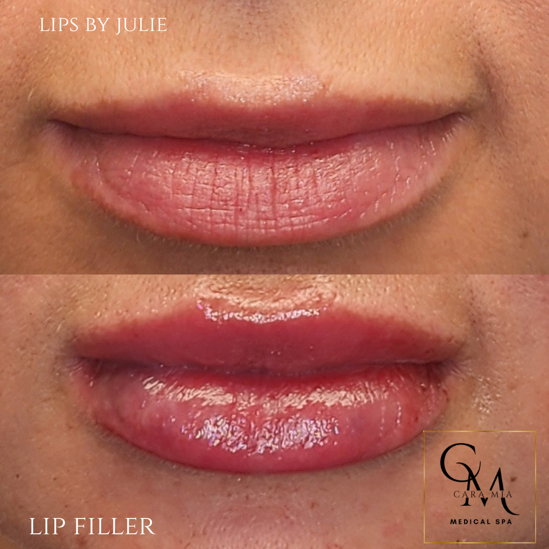 Before and after lip filler treatment: fuller lips, close-up.