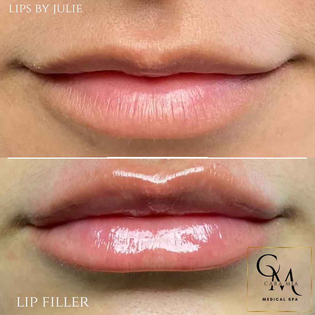 Comparison of lips before and after lip filler treatment. Bottom lips are fuller, glossier.
