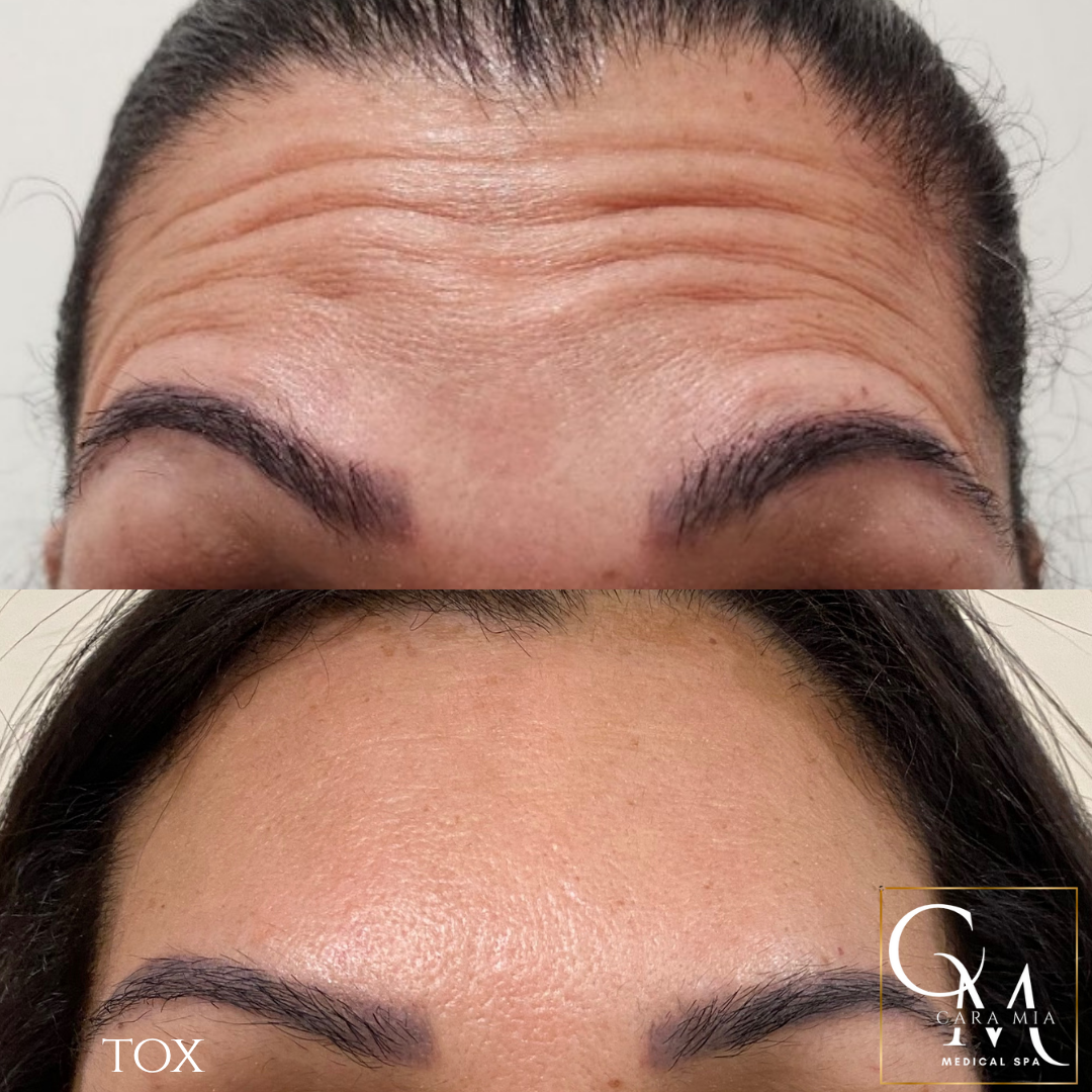 Forehead wrinkles before and after treatment, reducing lines.
