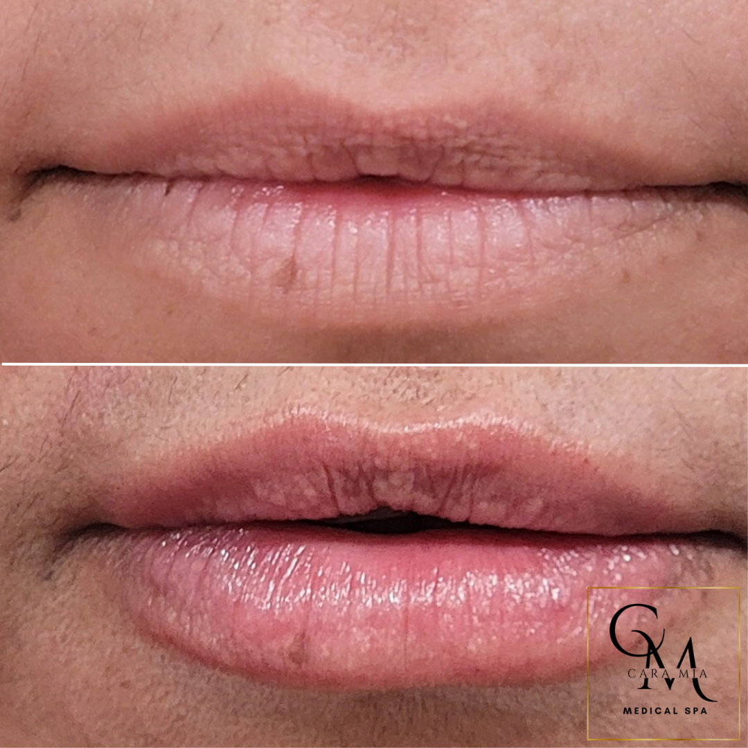 Before-and-after of lip fillers. Upper lip appears thin, bottom lip plumped after treatment.