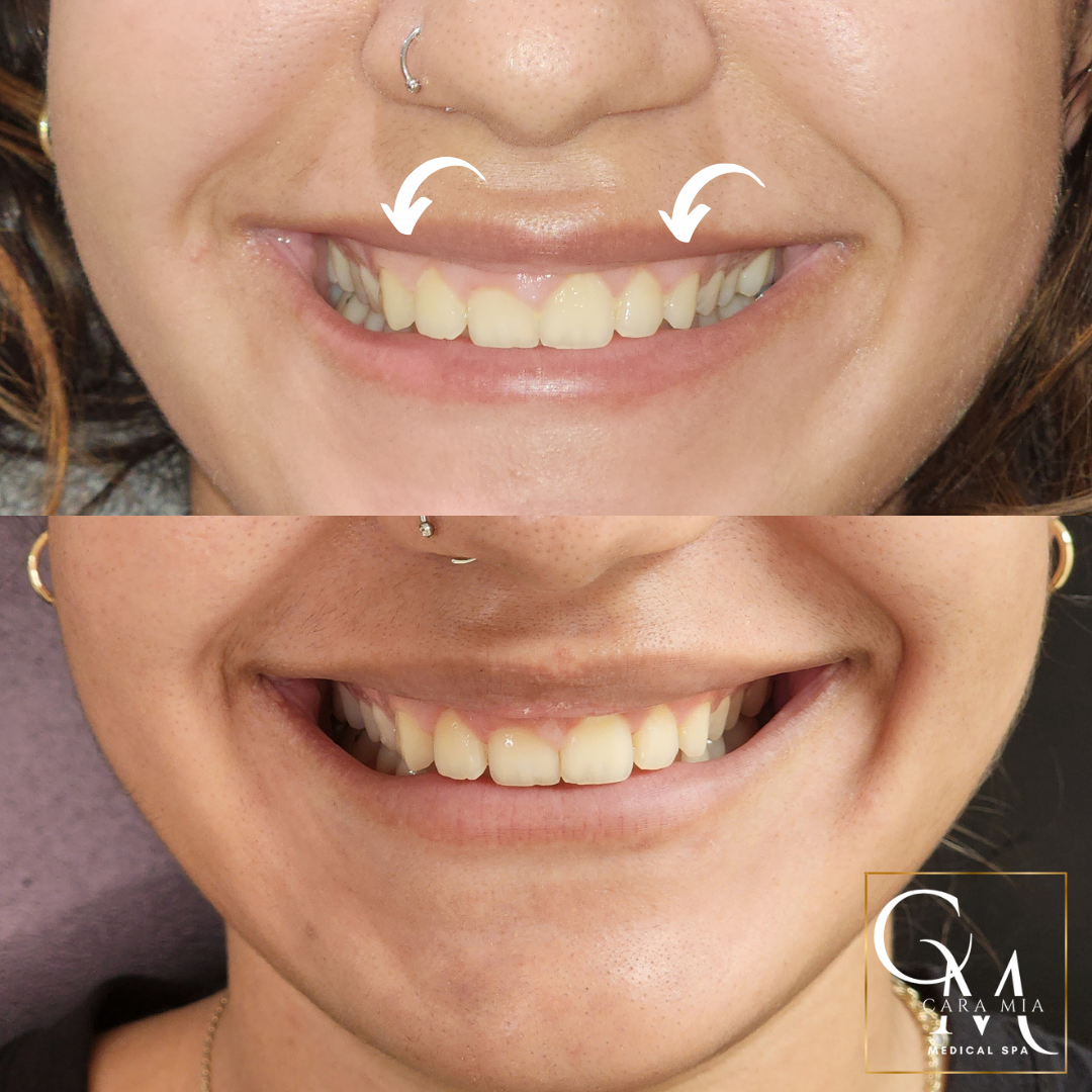 Before-and-after of a smiling mouth, showing tooth whitening, with arrows in the top image.