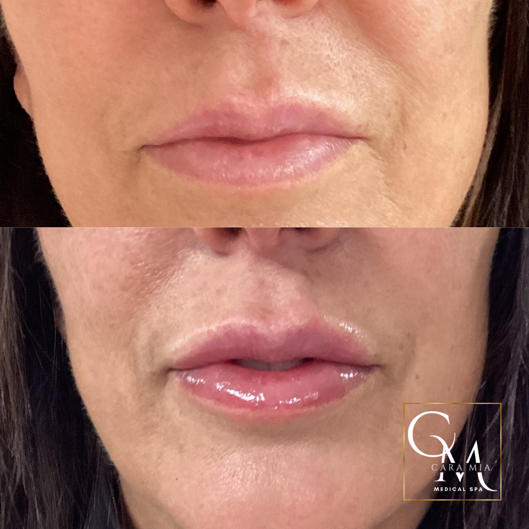 Before and after photos of lip augmentation showing increased volume and gloss.