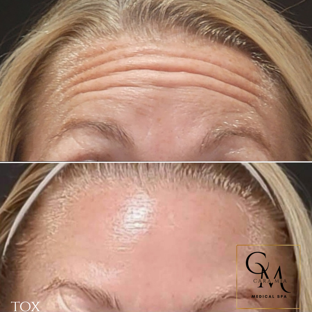 Forehead wrinkles before and after treatment, showing smoothing effect.