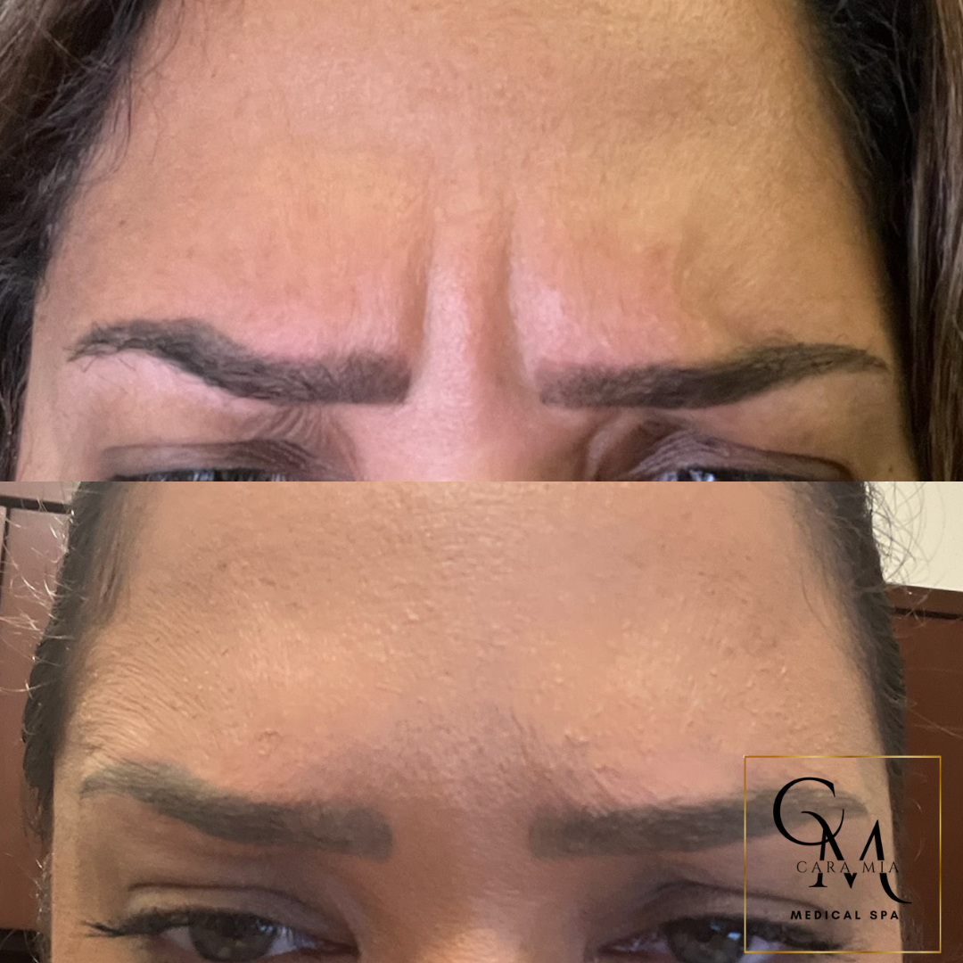 Before-and-after of forehead with reduced frown lines after cosmetic procedure.