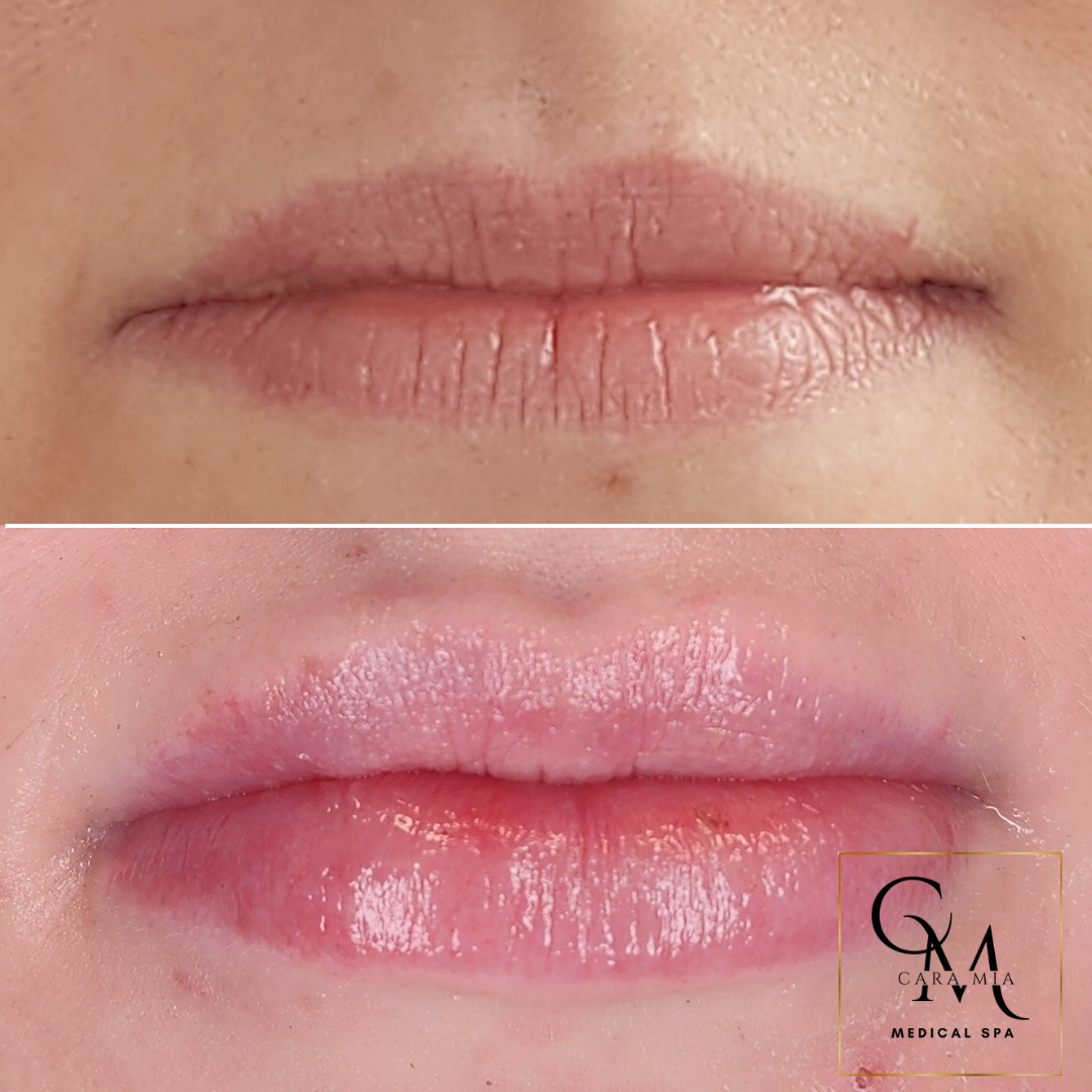 Before and after photos of lip enhancement; top lip, dry with lines; bottom lip, pink, glossy.