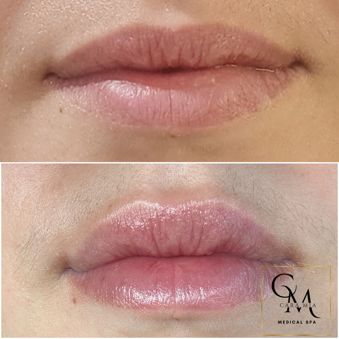 Before and after comparison of lip filler: top lips appear thinner, bottom lips fuller.