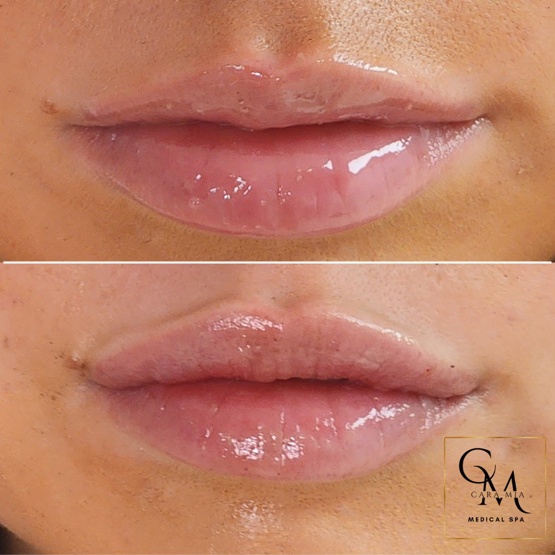 Two images of lips showing before and after lip filler treatment.