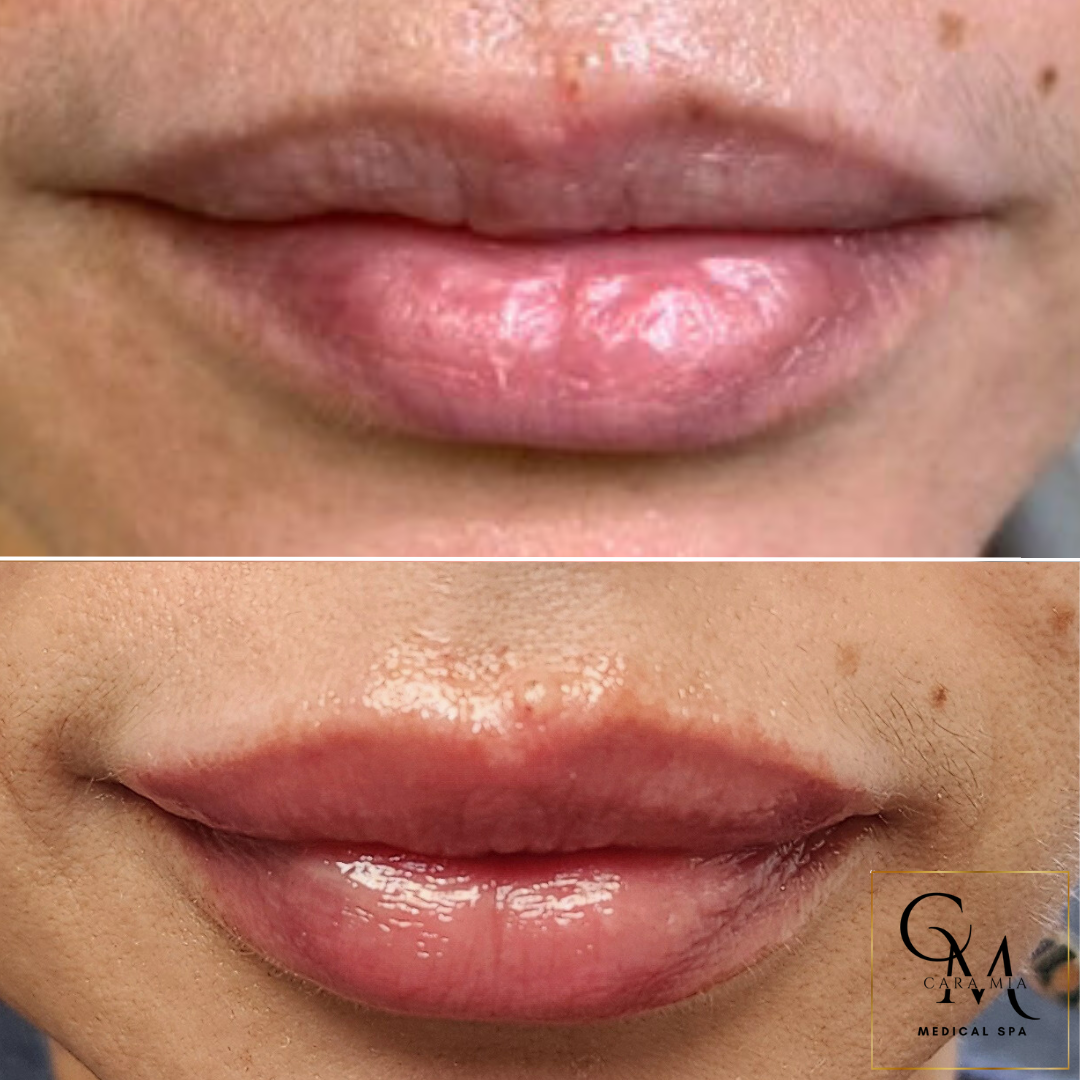 Before and after lip filler comparison: upper lips are fuller and more defined after treatment.