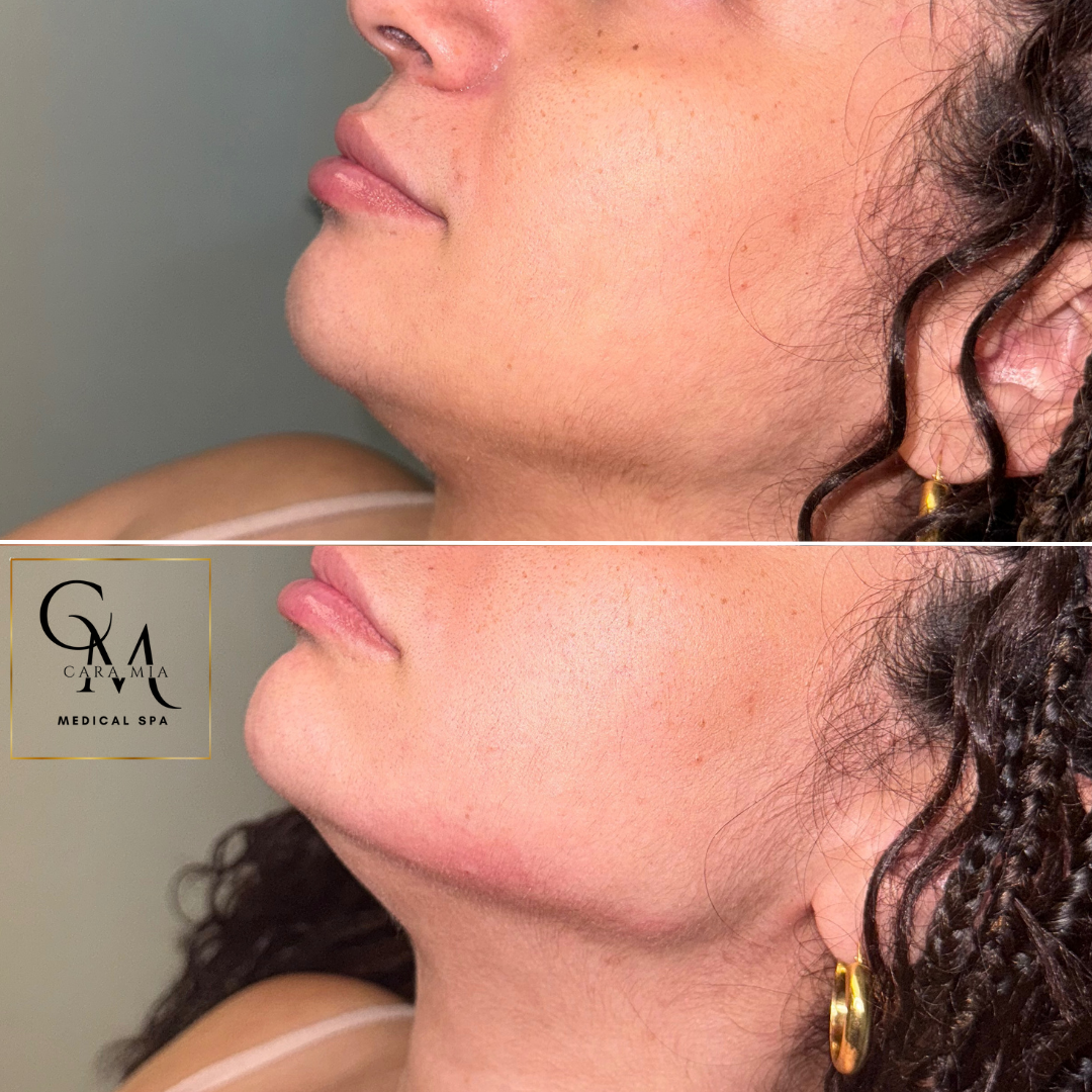 Before and after comparison of a person's chin/neck. Top: visible fullness. Bottom: reduced fullness, some redness.