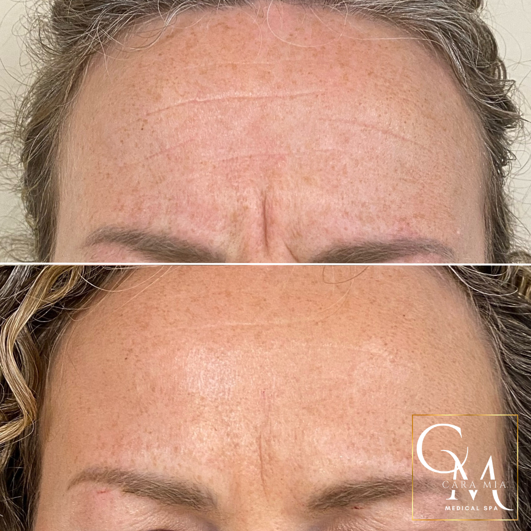 Before and after of a woman's forehead, showing reduction of wrinkles after treatment.
