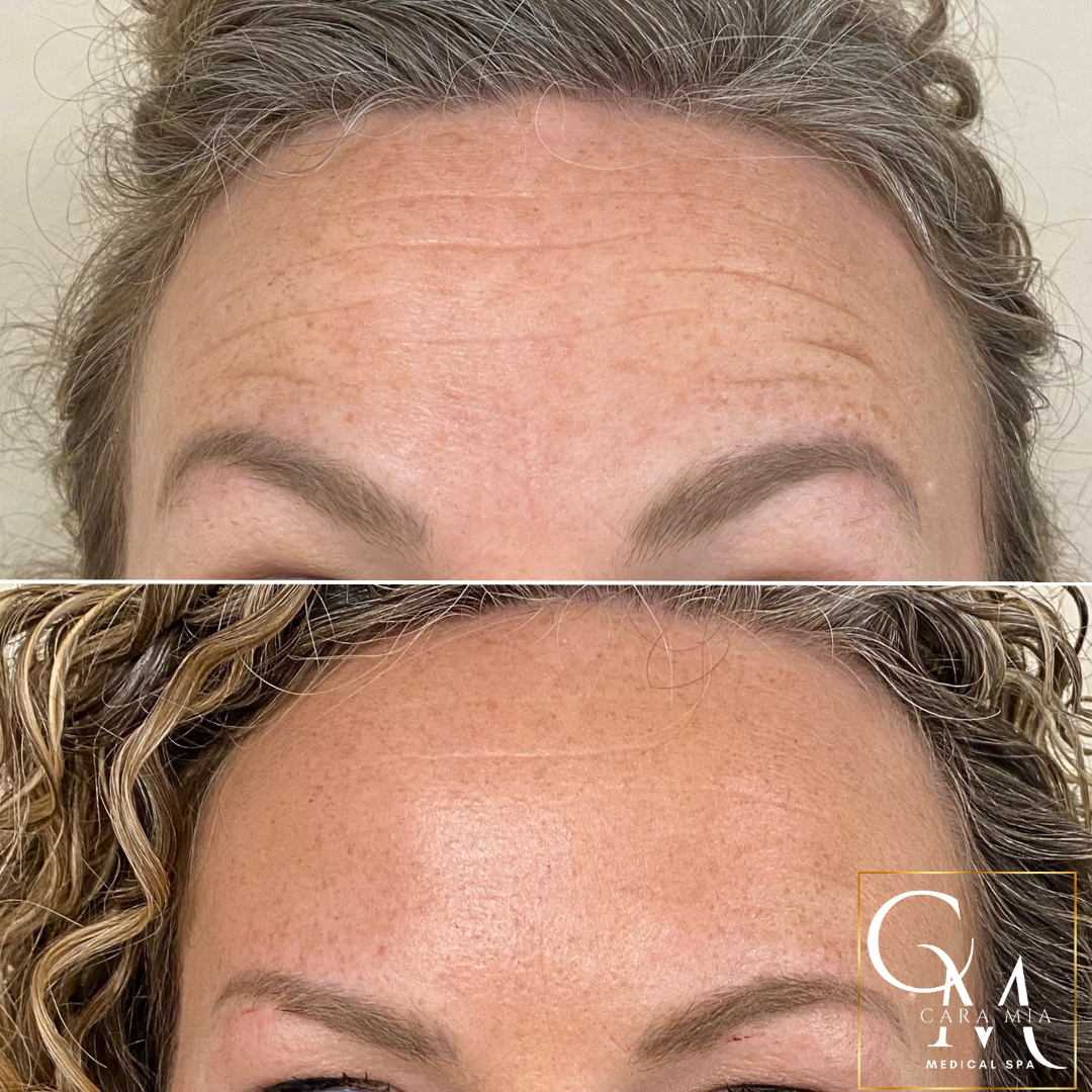 Before-and-after of a forehead showing a reduction of wrinkles. The top shows a wrinkled forehead; the bottom is smoother.