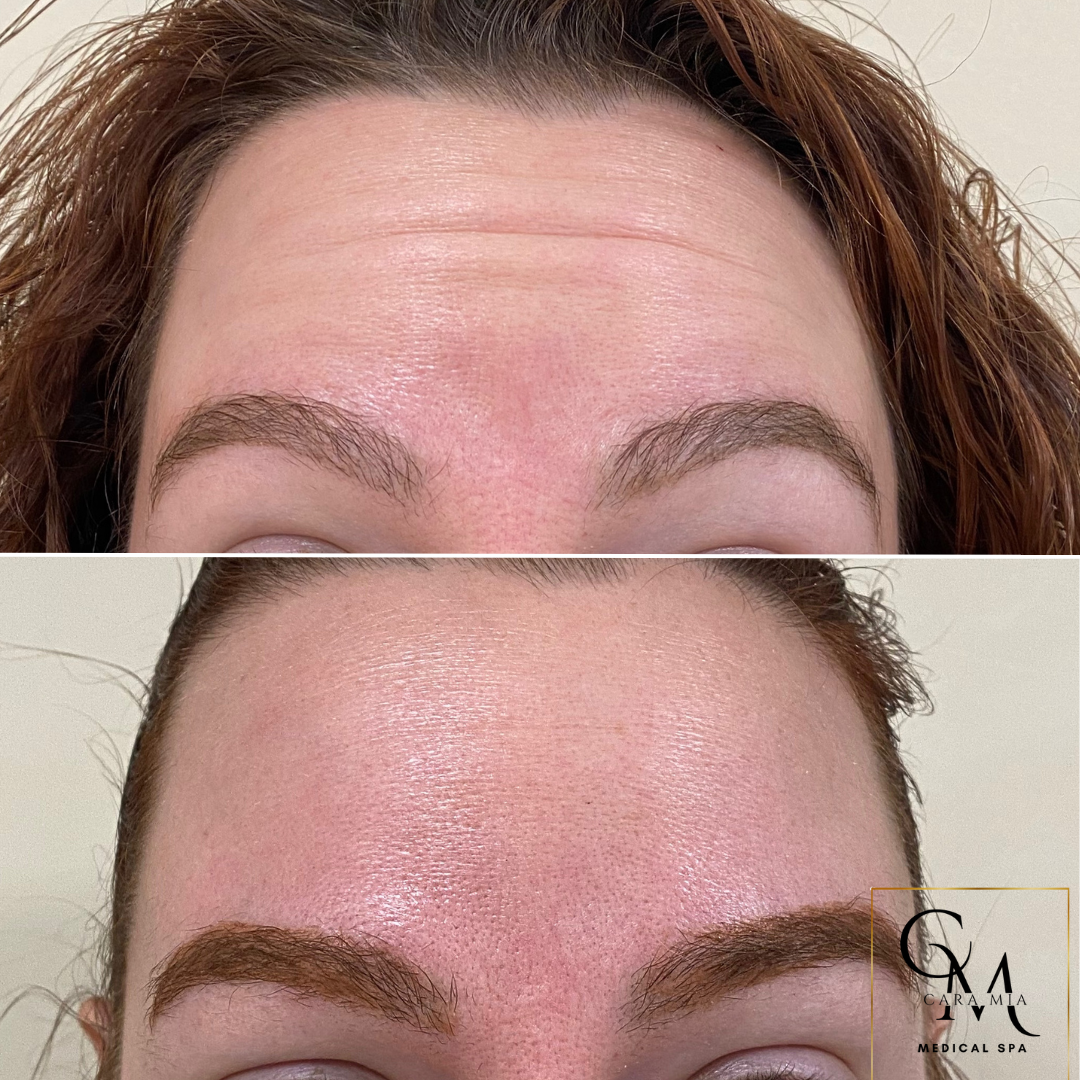 Before and after photos of a forehead with fewer wrinkles after a cosmetic procedure.