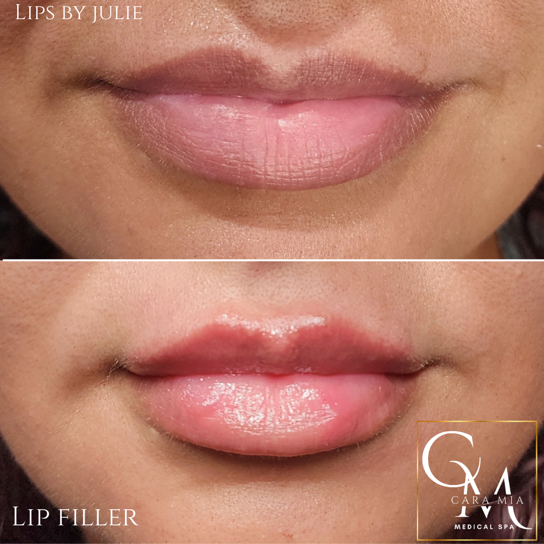 Before and after lip filler; fuller, plumper lips with a glossy finish.