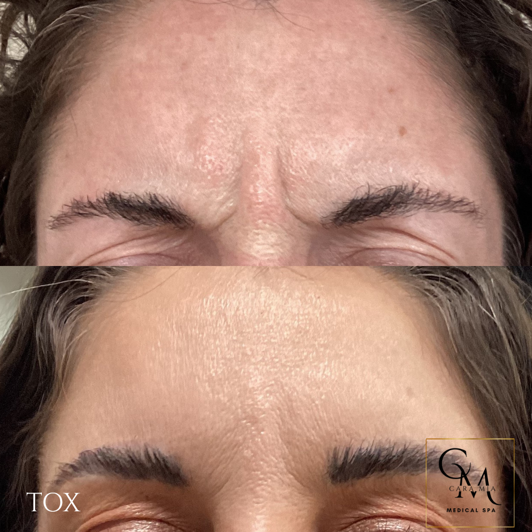 Comparison of forehead wrinkles before and after toxin injection.