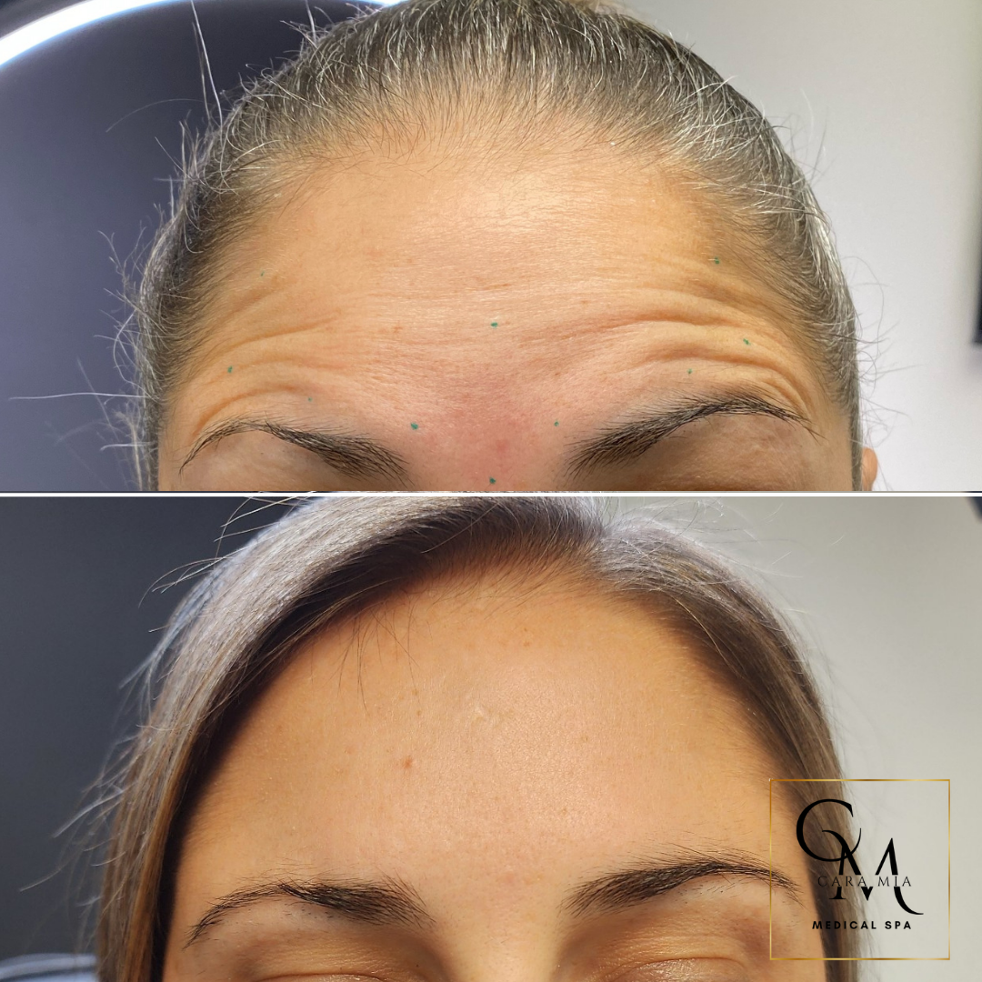 Before and after comparison of a woman's forehead, showing reduction in wrinkles after cosmetic treatment.