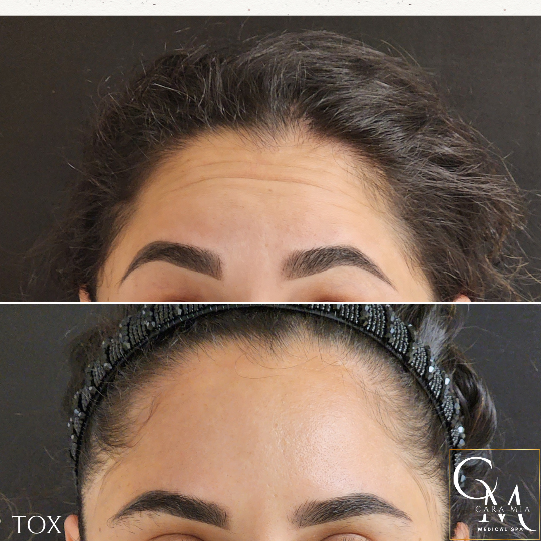 Before-and-after comparison of a woman's forehead; showing wrinkles before and smoothed skin after treatment.