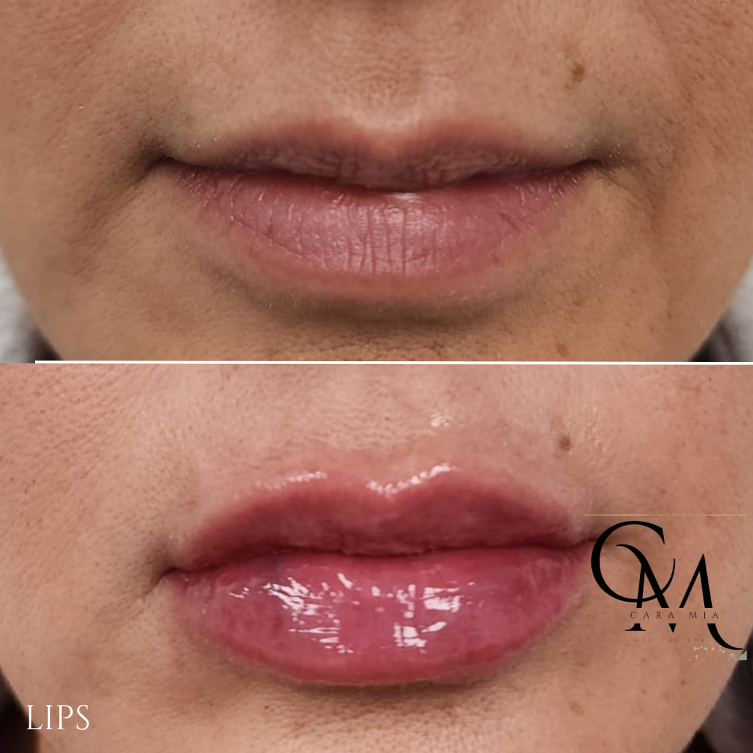 Before-and-after of lip fillers; top is smaller lips, bottom is fuller, glossier lips.