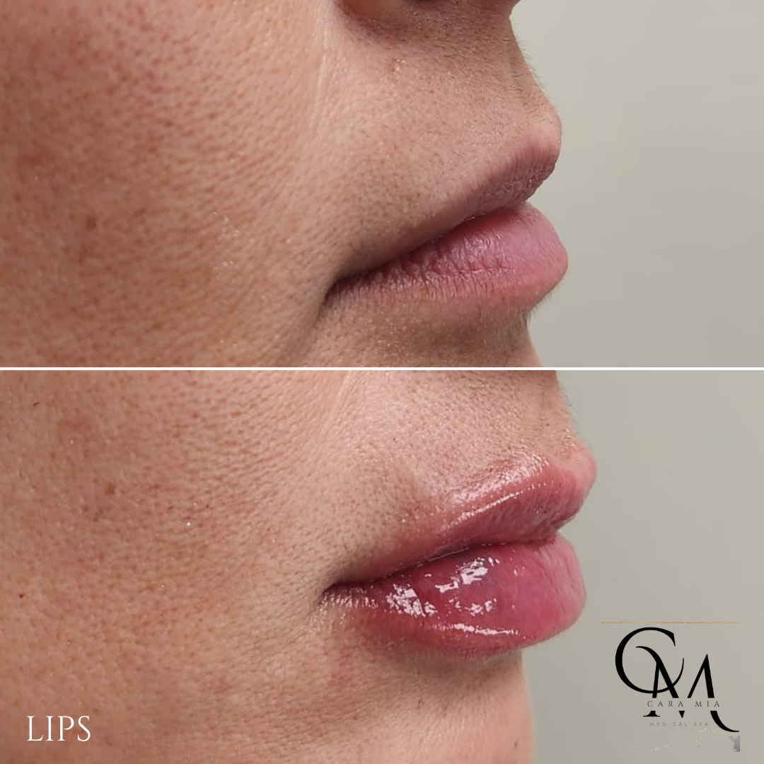 Before and after lip filler treatment: lips appear thinner in the top image and fuller, with gloss, in the bottom.