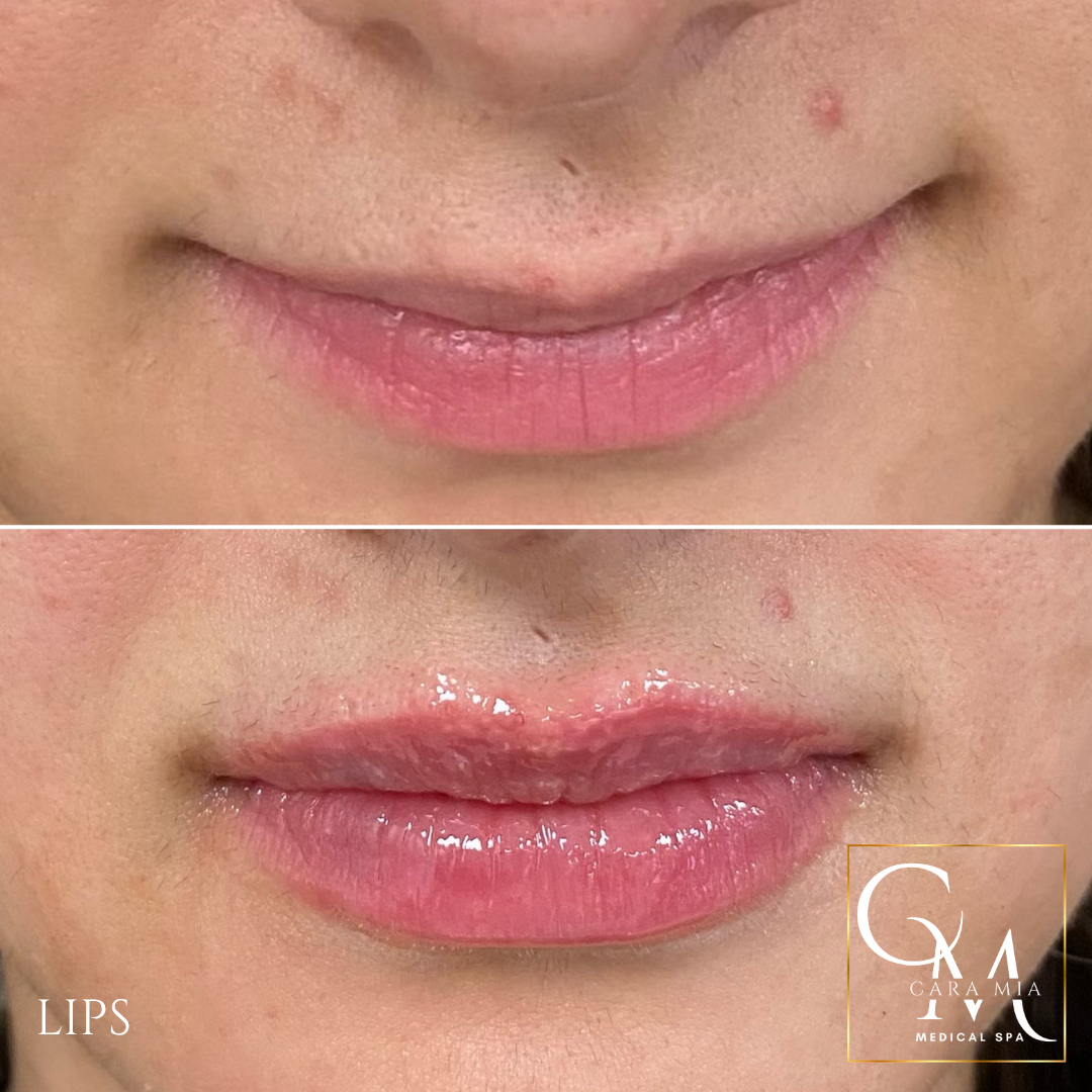 Before and after lip filler treatment: fuller lips, pink gloss.