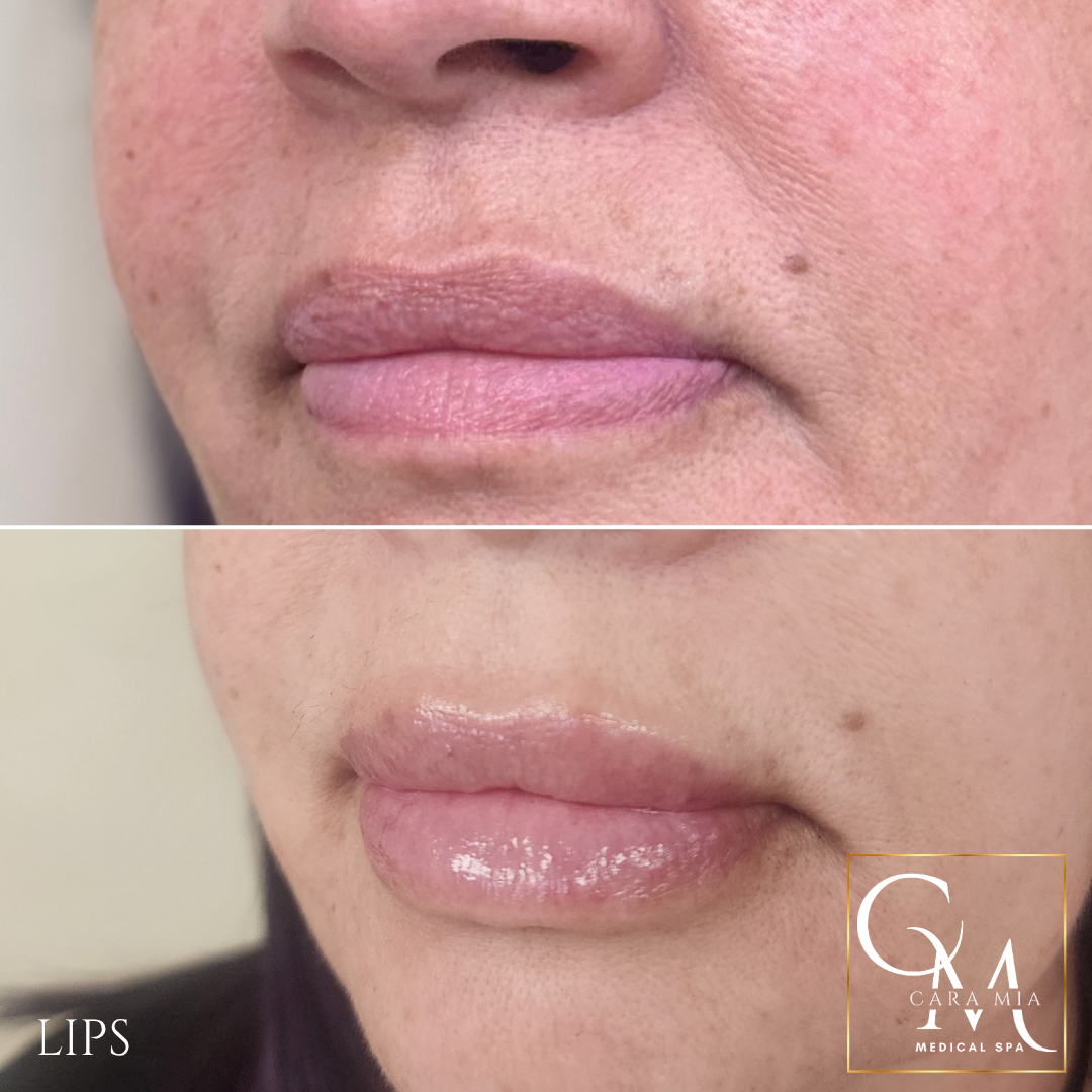 Before-and-after of lips; top: thin lips, bottom: fuller lips, with gloss applied.