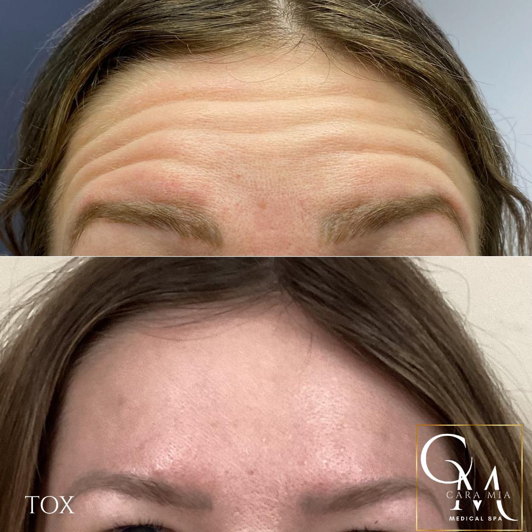 Before and after photos of a forehead; top shows wrinkles, bottom shows smooth skin.