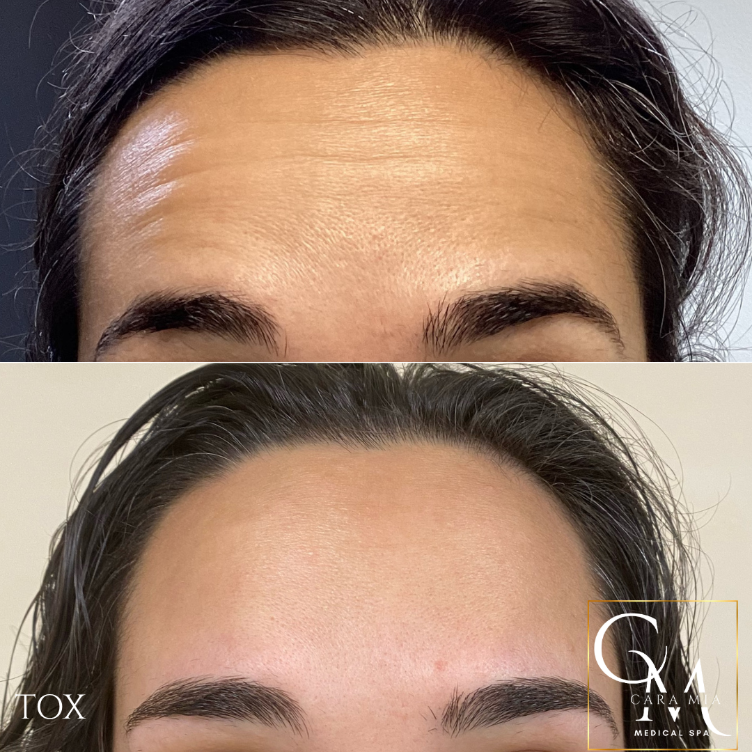 Before-and-after of forehead, showing reduction of wrinkles after treatment.