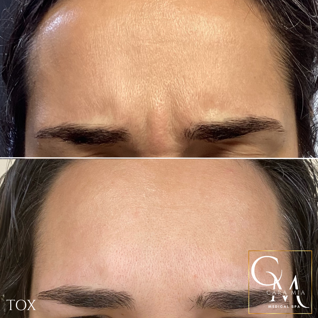 Before and after comparison of forehead wrinkles, smoothed after treatment.