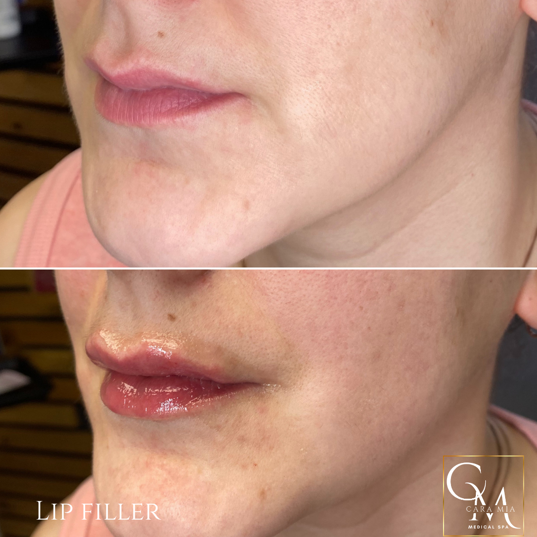 Before and after lip filler treatment: fuller lips, close-up on the lower face.
