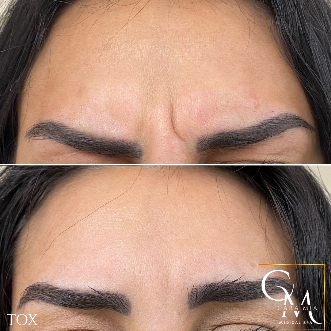Before-and-after of forehead with wrinkles, post-treatment, showing smoother skin between eyebrows.