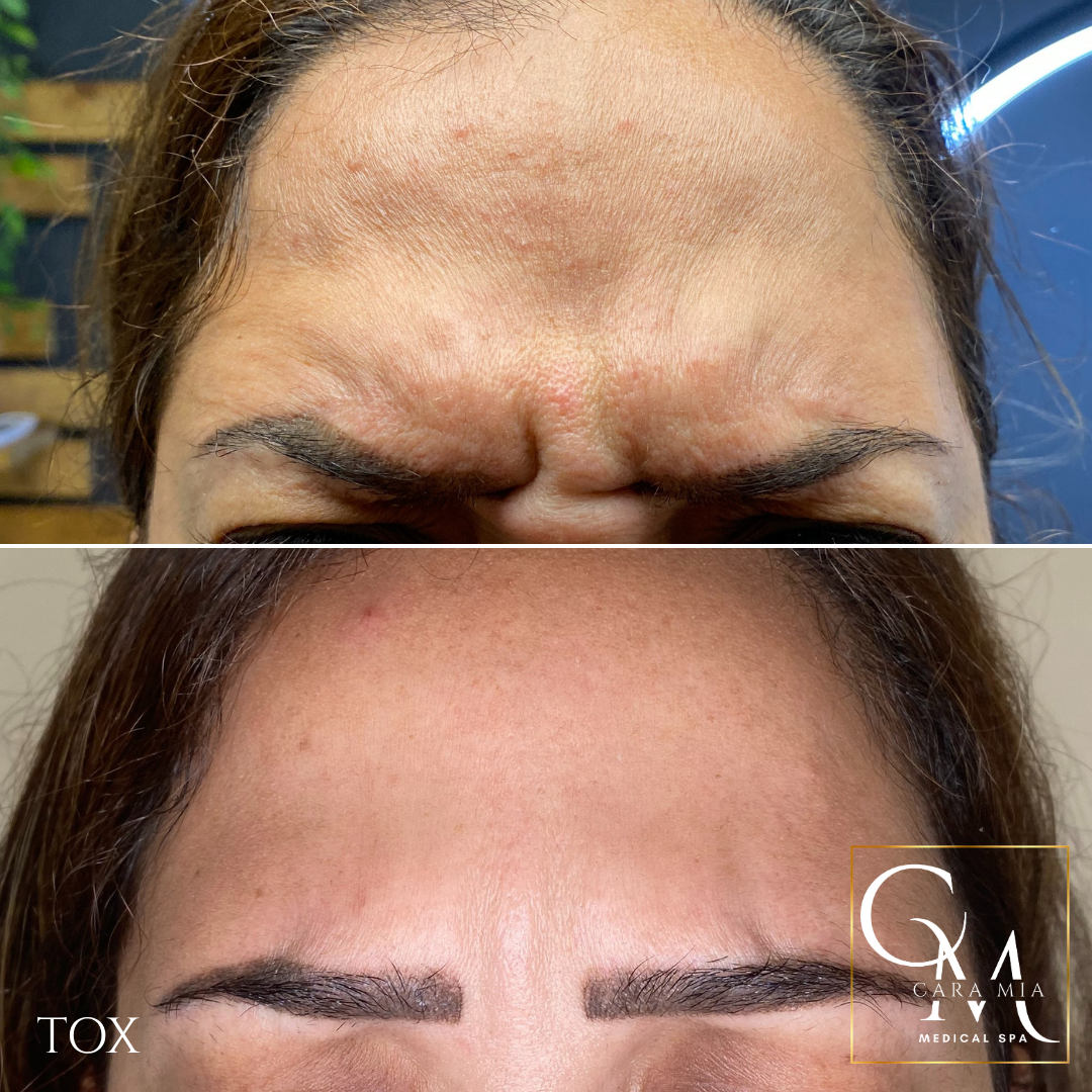 Comparison of a forehead with wrinkles (top) before and smoother after 