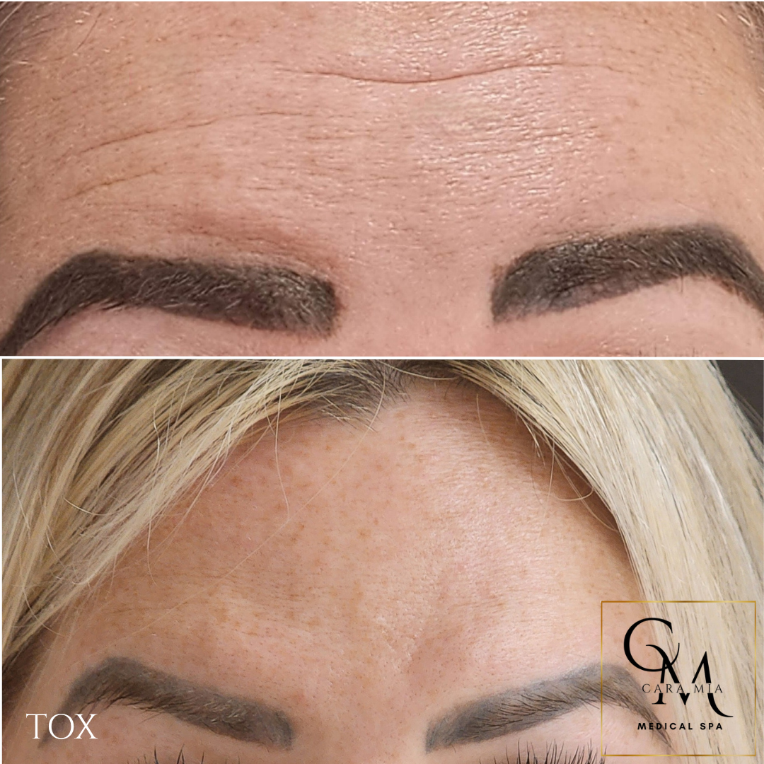 Before-and-after of forehead, showing wrinkles before and smoother skin after a 