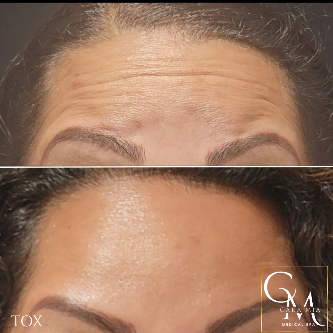 Before and after view of a forehead with wrinkles, showing a smoother appearance after a cosmetic treatment.