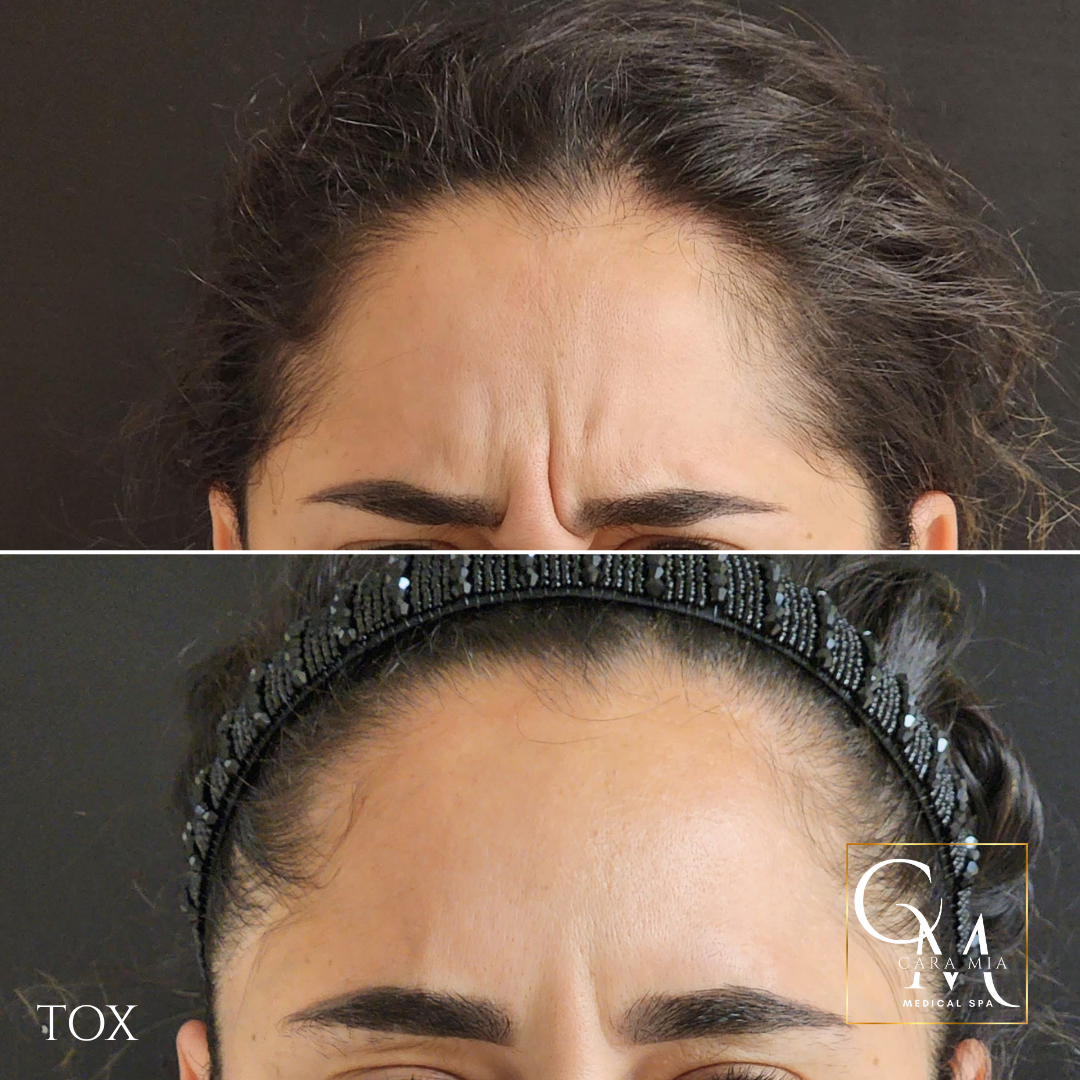 Forehead before and after treatment, showing reduction of wrinkles, with a beaded headband.