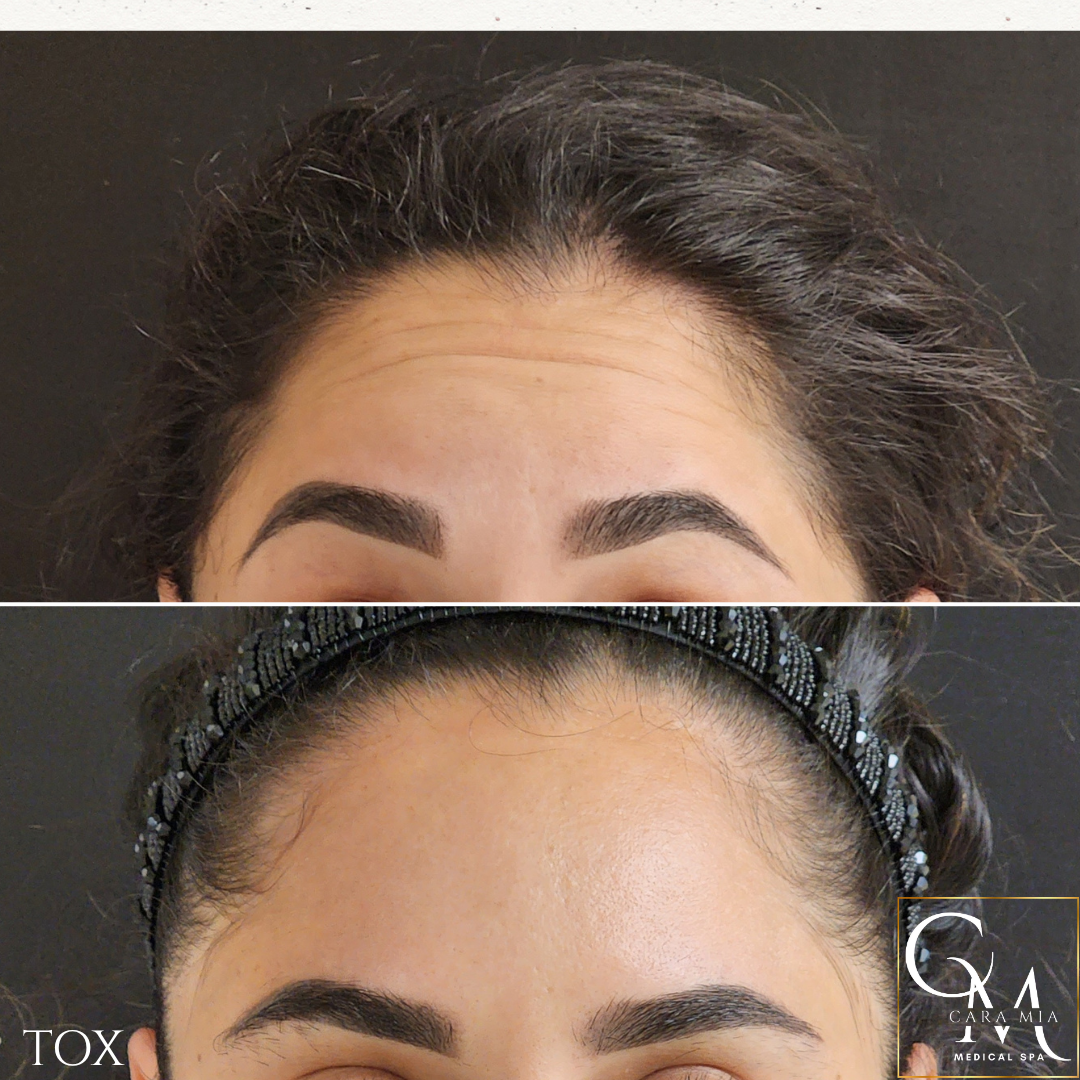 Forehead comparison: Before showing wrinkles, after smooth skin.  Dark hair and eyebrows in both.