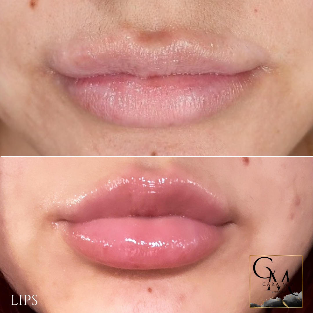 Two sets of lips before and after lip filler treatment; fuller, pinker, and glossier lips in the after photo.