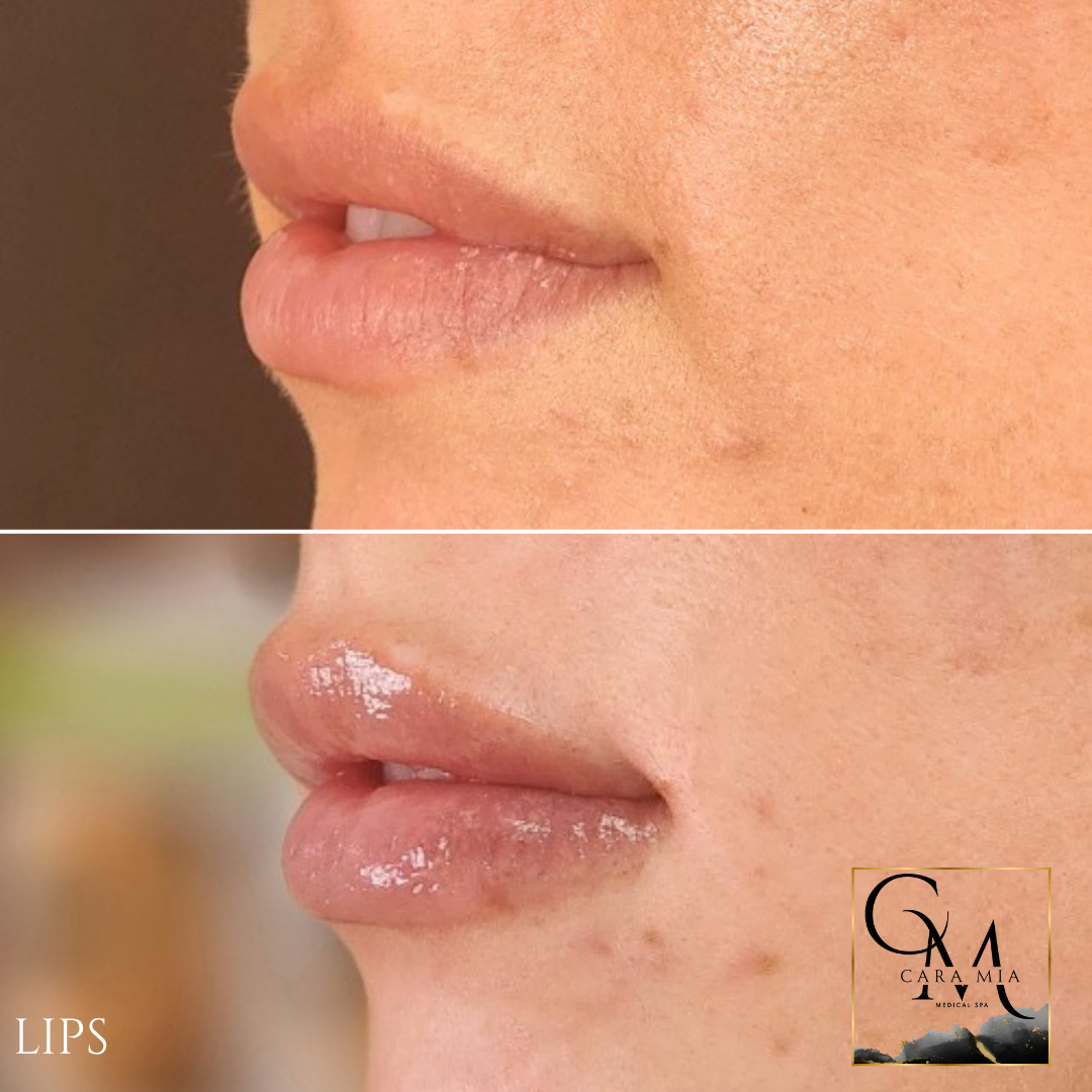 Comparison of lips: before and after lip filler treatment. Bottom lip shows increased volume.