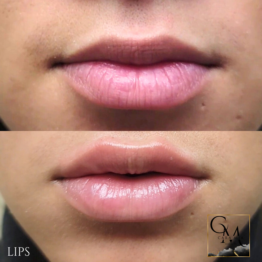 Lips before and after lip filler treatment; fuller, more defined shape.