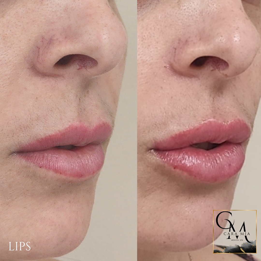 Before and after lip filler treatment: fuller lips, close-up of face with nose visible.