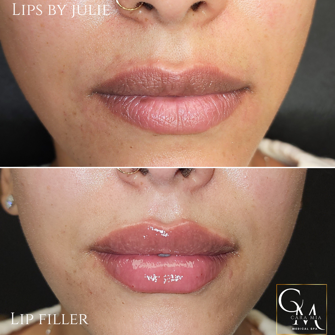 Before and after lip filler treatment: fuller, glossier lips.